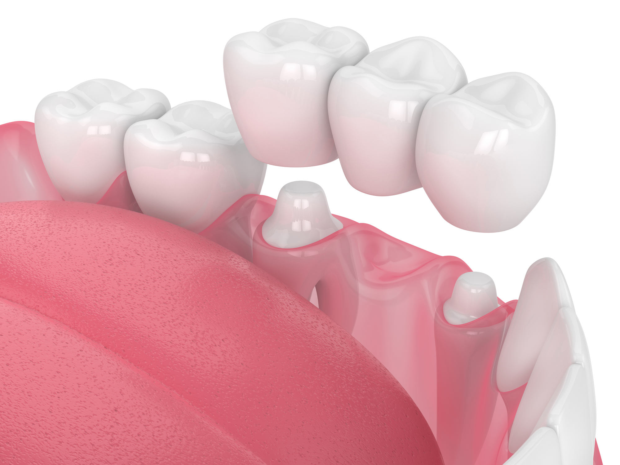 3d render Protesi
